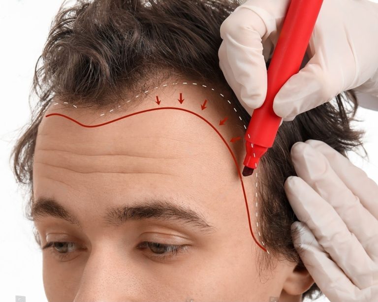 stock-photo-doctor-marking-forehead-of-young-man-with-hair-loss-problem-on-white-background-closeup-2398301029-transformed