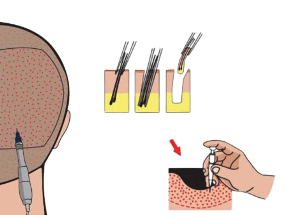 Removing and Preparing Hair Follicles