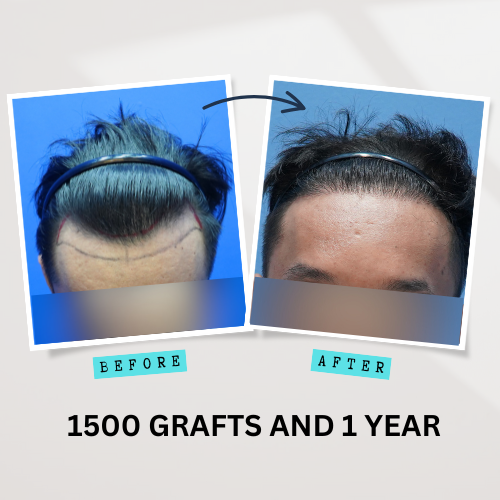 Contact us at InnoSurgicalCare - 1500 Grafts & 1 Year