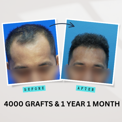 Contact us at InnoSurgicalCare - 4000 Grafts & 1 Year 1 Month