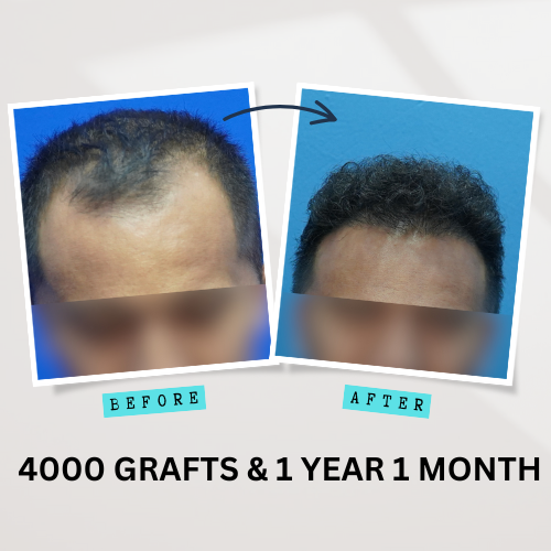 4000 GRAFTS & 1 YEAR 1 MONTH Before after
