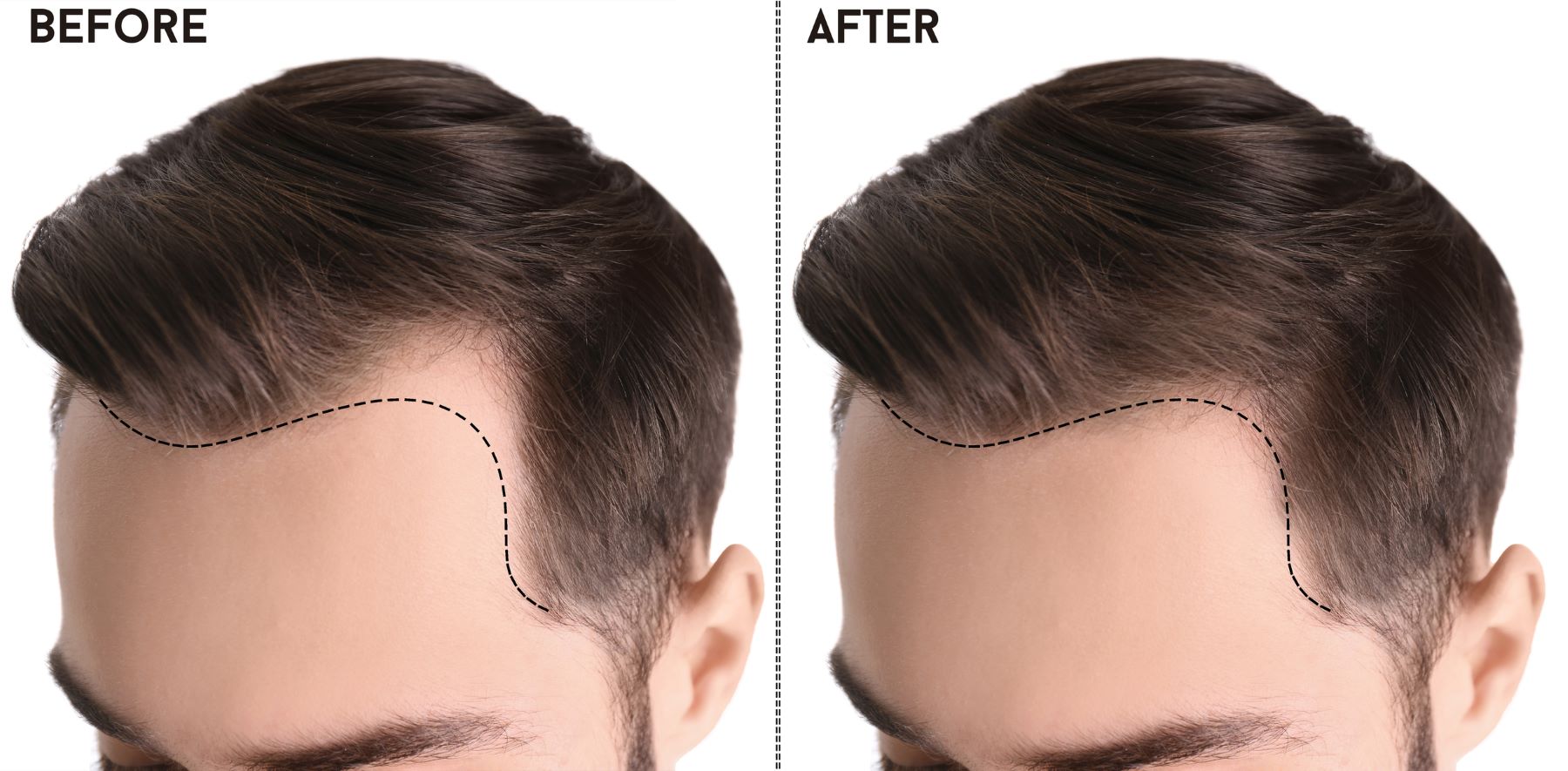 hairline implant
