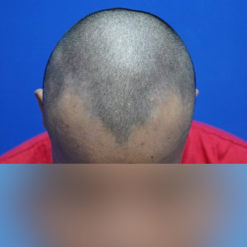 M-Shape Hair Transplant