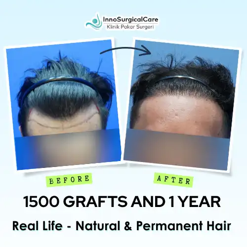 1500-GRAFTS-AND-1-YEAR-Before-after-ezgif.com-png-to-webp-converter