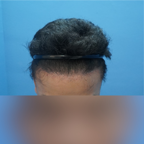 M-Shape Hair Transplant
