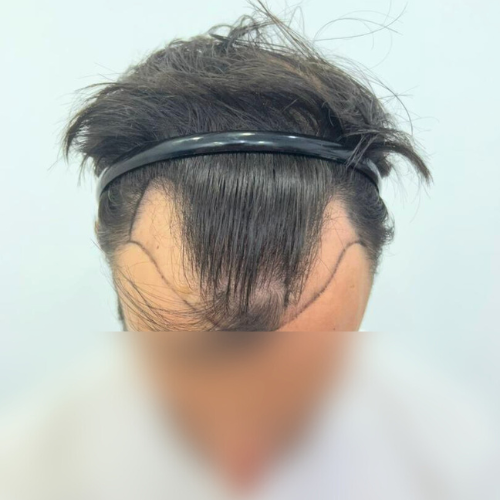 M-Shape Hair Transplant (1)