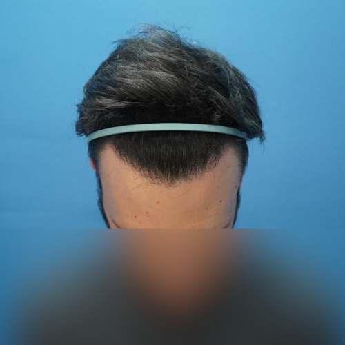 M-Shape Hair Transplant