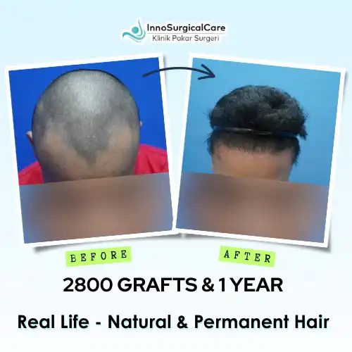 2800-GRAFTS-1-YEAR-Before-after-ezgif.com-png-to-webp-converter