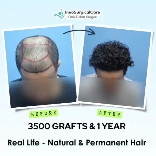 3500-GRAFTS-1-YEAR-Before-after-ezgif.com-png-to-webp-converter