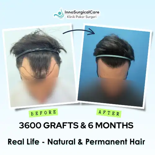 3600-GRAFTS-6-MONTHS-Before-after-ezgif.com-png-to-webp-converter