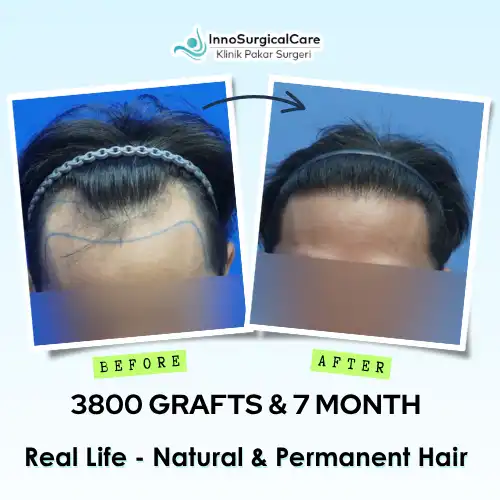 3800-GRAFTS-7-MONTH-Before-after-ezgif.com-png-to-webp-converter