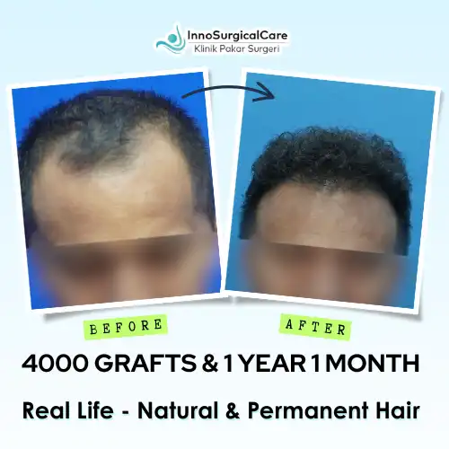4000-GRAFTS-1-YEAR-1-MONTH-Before-after-ezgif.com-png-to-webp-converter
