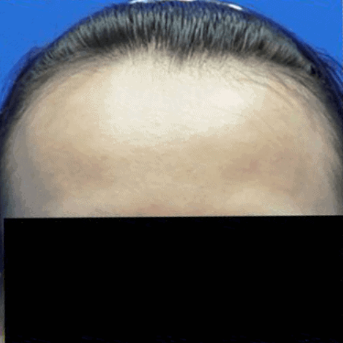 Before After (500x500)