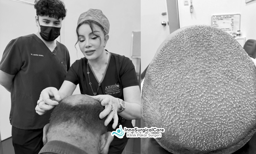 Crown Hair Transplant