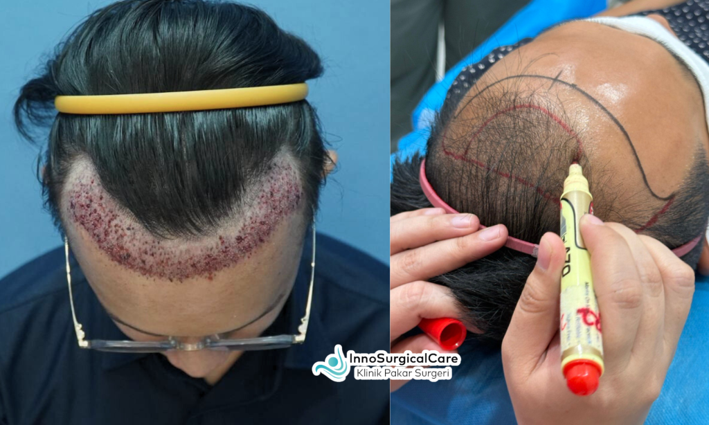 M-Shape Hair Transplant (1)